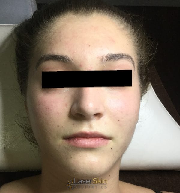 Before-Acne Two