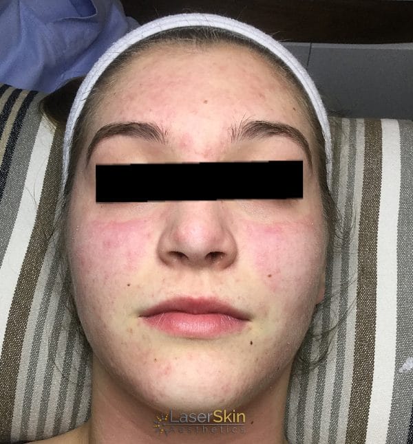 After-Acne Two