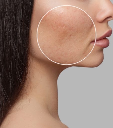 Acne Scarring Laser Skin Aesthetics