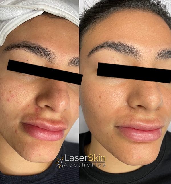 Carbon Laser Peel Before and After Photo 3