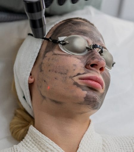 Carbon Laser Peel Treatment Image