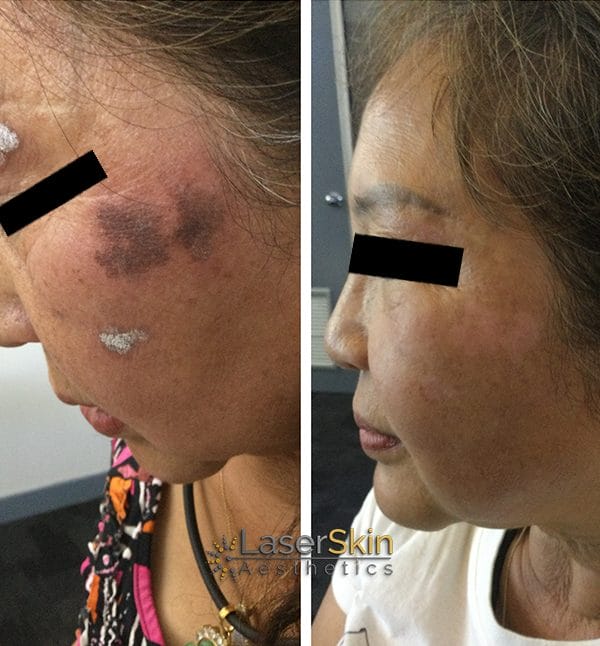 Carbon Laser Peel Before and After one Laser Skin Aesthetics