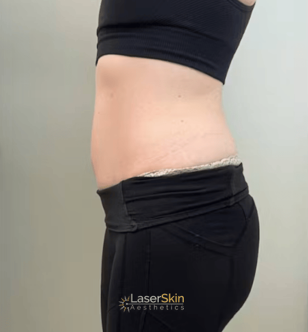 Before-Body Contouring B&A1