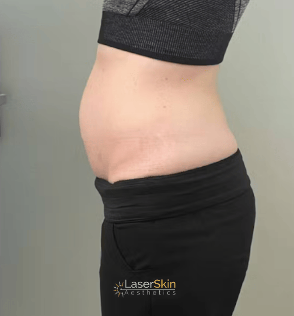 After-Body Contouring B&A1