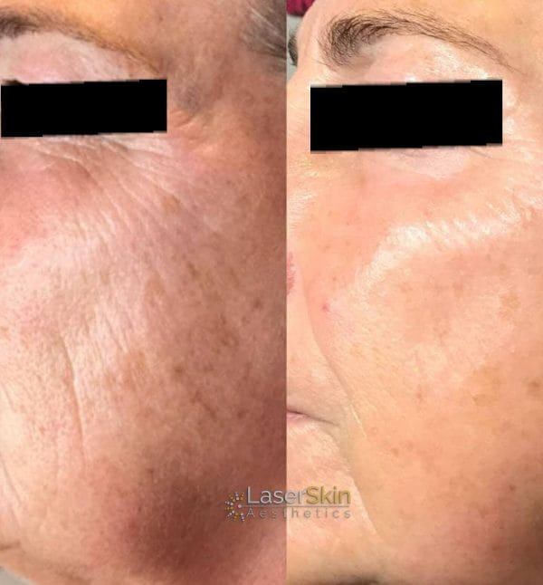 Fine Lines Wrinkles Laser Skin Aesthetics East Perth