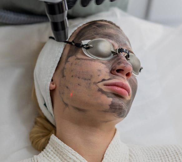 Laser Carbon Peel - Laser Skin Aesthetics