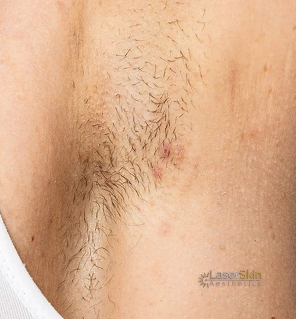 After-Laser Hair Removal B&A3