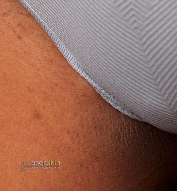 Before-Laser Hair Removal B&A1