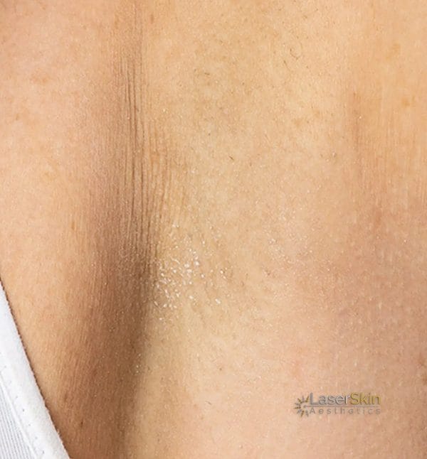 Before-Laser Hair Removal B&A3