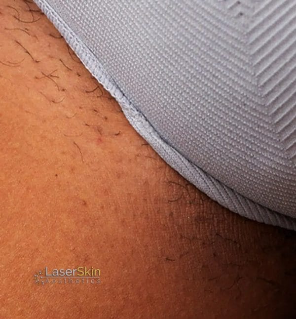 After-Laser Hair Removal B&A1