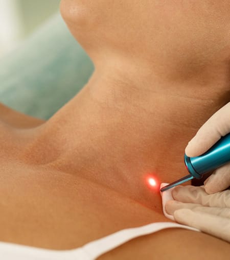 Laser-Rejuvenation-Neck