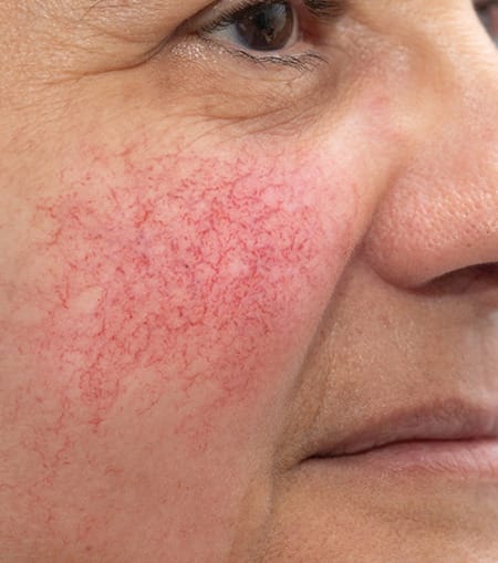 Laser-Rosacea-Treatment