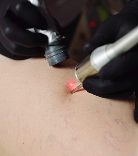 Laser-Vascular-Treatment