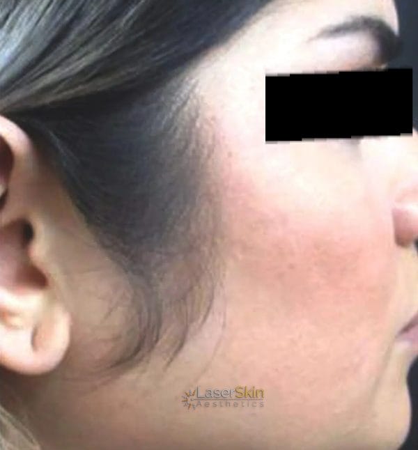 After-Laser Hair Removal B&A2