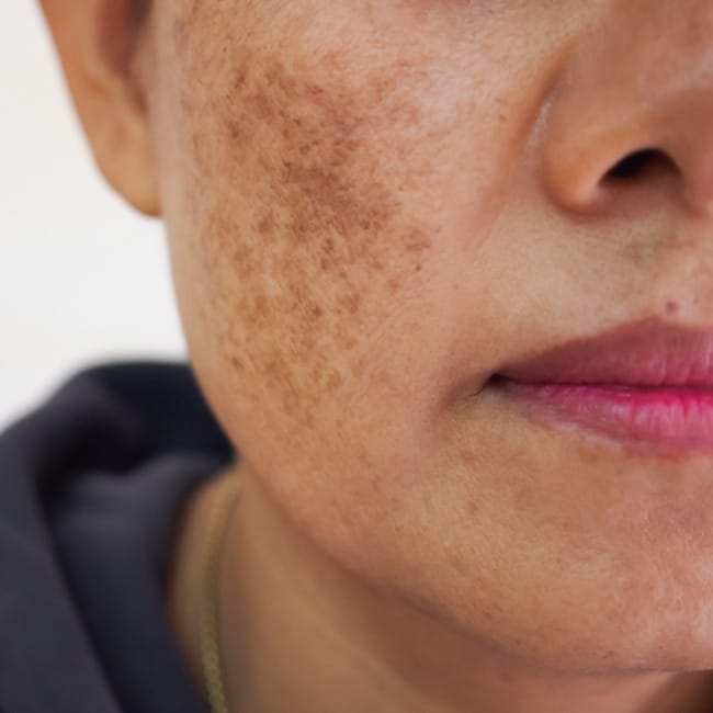 pigmentation-removal-treatment