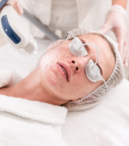 Laser Acne Treatment Pore Reduction
