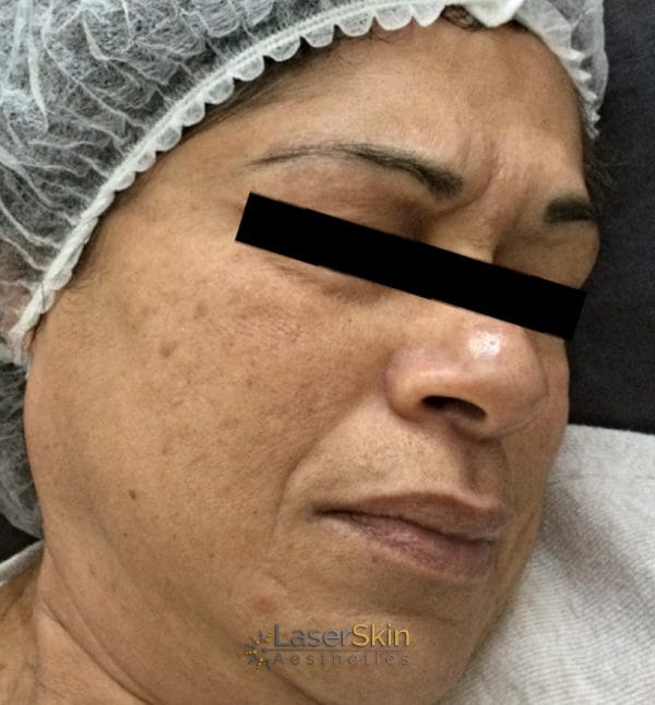 After-RF Skin Tightening One