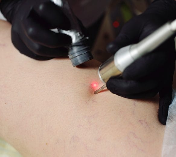 Laser Spider Veins Removal